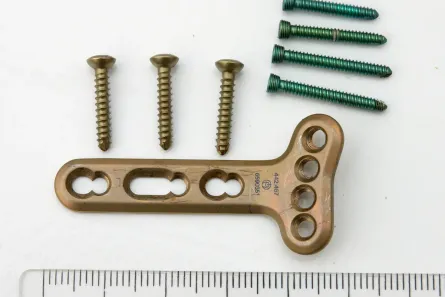 Implantes inteligentes de titanio: superficies antibacterianas y dispositivos médicos impresos en 3D
